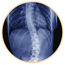 scoliosis-back-pain-osteopathy-canberra-woden-osteopath